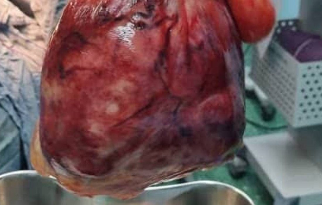 خارج کردن توده ۵ کیلویی از شکم خانم ۴۲ ساله کردستانی