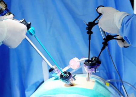 نخستین عمل جراحی پیشرفته آپاندیس در سنندج انجام شد